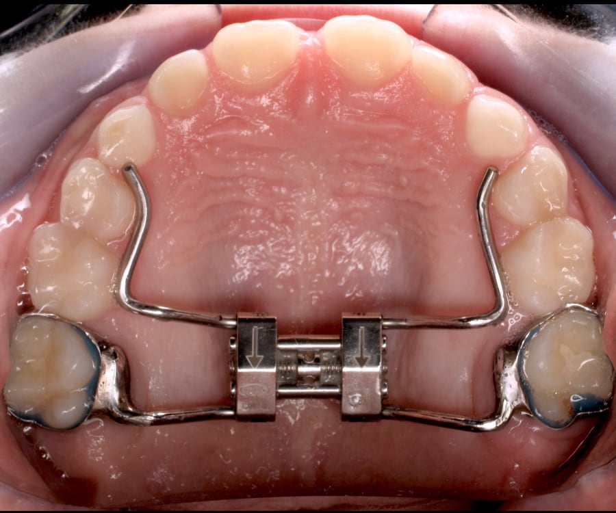 A palate expander fitted across the roof of a child's mouth, attached to the upper back teeth